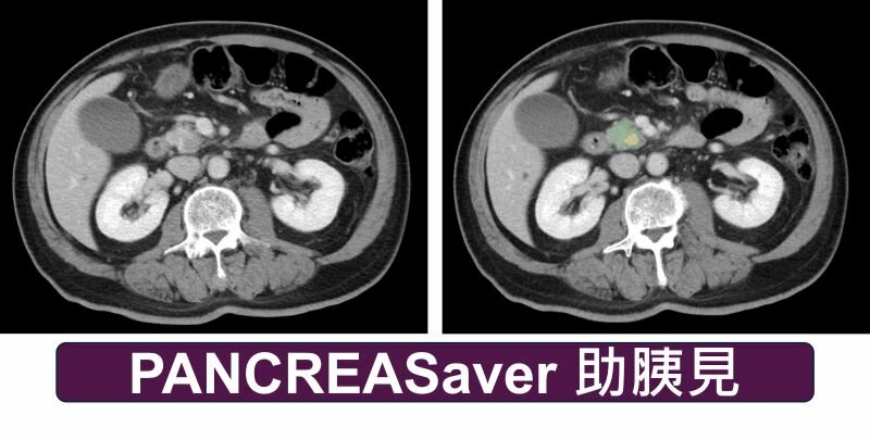 PANCREASaver對早期胰臟腫瘤具備高診斷準確率，擁有台、美共9項專利，並榮獲多個國內外獎項殊榮。(圖片來源/台大人工智慧與機器人研究中心&全幅健康照護中心)