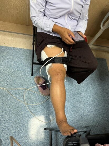 經12個月光生物調節治療後，陳女士右腿腫脹已獲得大幅緩解。(圖片來源/安力達科技)